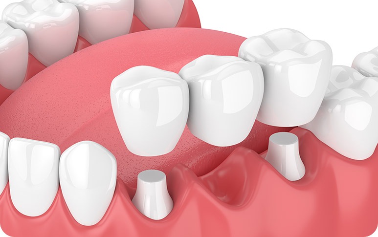 NE Calgary Dental Bridges | Redstone Smiles Dental | General and Family Dentist | NE Calgary Dentist