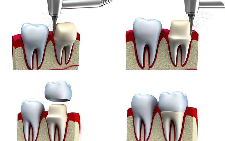 NE Calgary Dental Crowns | Redstone Smiles Dental | General and Family Dentist | NE Calgary Dentist