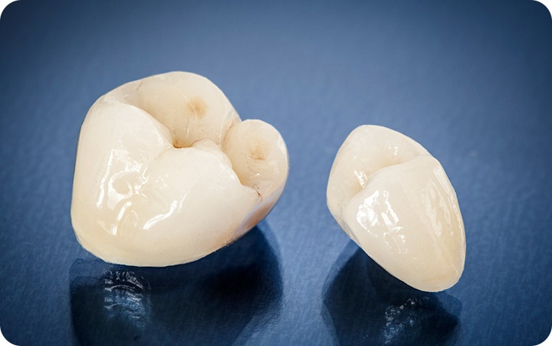 NE Calgary Dental Crowns | Redstone Smiles Dental | NE Calgary Dentist