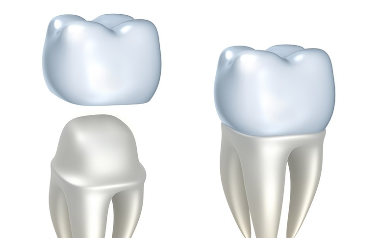 NE Calgary Dental Crowns | Redstone Smiles Dental | General and Family Dentist | NE Calgary Dentist