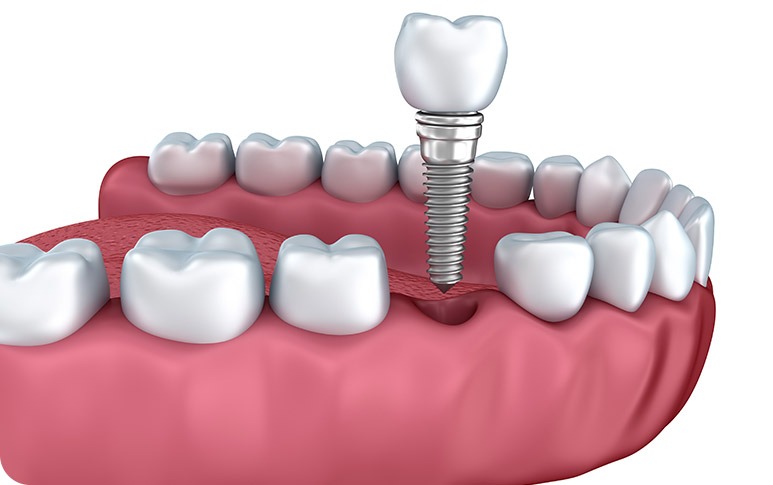 NE Calgary Dental Implants | Redstone Smiles Dental | General and Family Dentist | NE Calgary Dentist