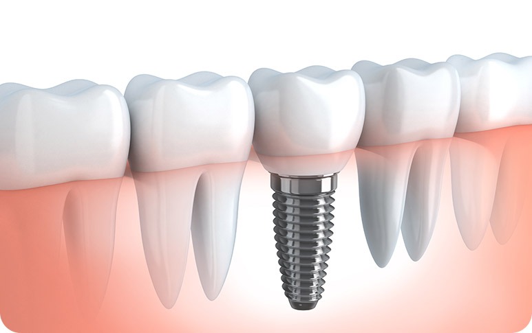 NE Calgary Dental Implants | Redstone Smiles Dental | General and Family Dentist | NE Calgary Dentist