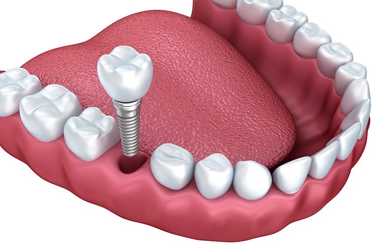 NE Calgary Dental Implants | Redstone Smiles Dental | General and Family Dentist | NE Calgary Dentist