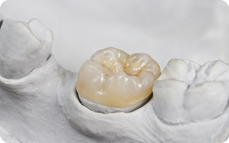 NE Calgary Dental Inlays & Onlays | Redstone Smiles Dental | General and Family Dentist | NE Calgary Dentist