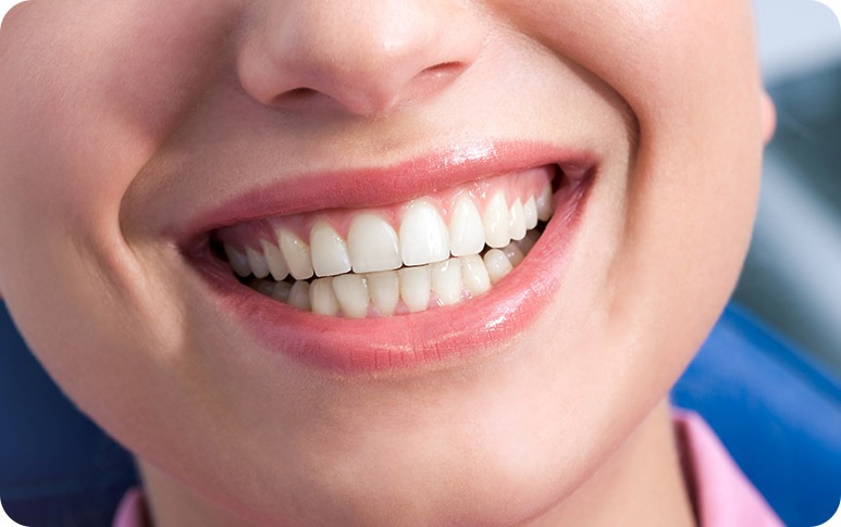 NE Calgary Dental Inlays & Onlays | Redstone Smiles Dental | General and Family Dentist | NE Calgar Dentisty