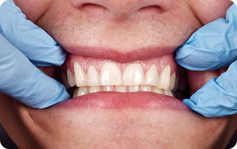 NE Calgary Gum Contouring | Redstone Smiles Dental | General and Family Dentist | NE Calgary Dentist