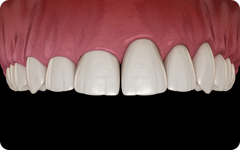 NE Calgary Gum Contouring | Redstone Smiles Dental | General and Family Dentist | NE Calgary Dentist