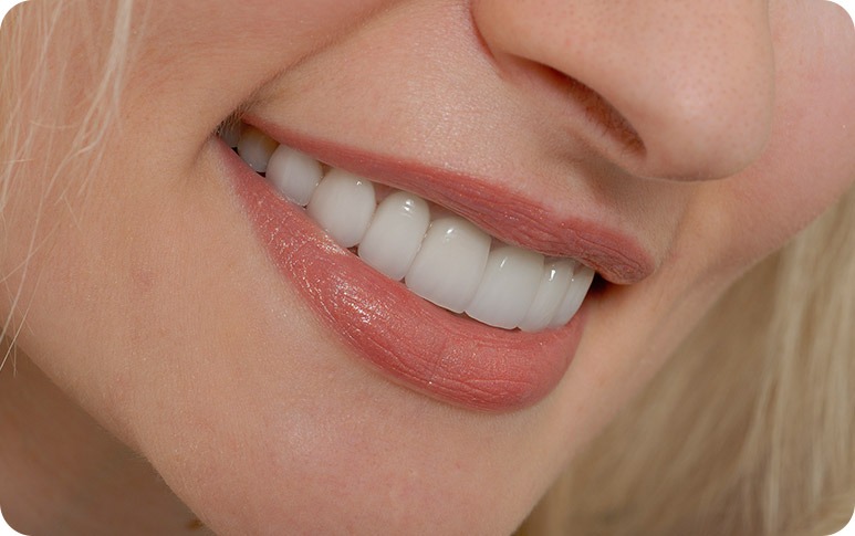 NE Calgary Porcelain Veneers | Redstone Smiles Dental | General and Family Dentist | NE Calgary Dentist