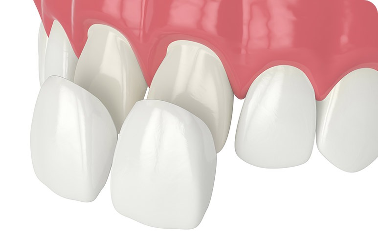 NE Calgary Porcelain Veneers | Redstone Smiles Dental | General and Family Dentist | NE Calgary Dentist