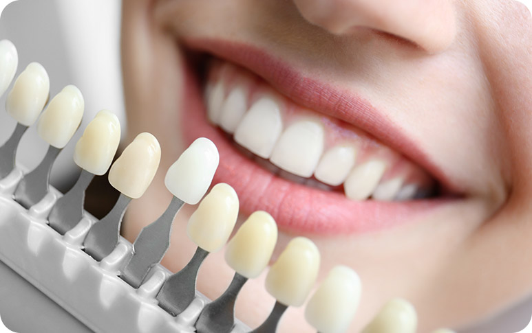 NE Calgary Porcelain Veneers | Redstone Smiles Dental | General and Family Dentist | NE Calgary Dentist