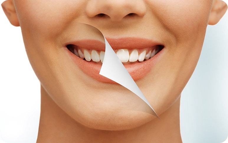NE Calgary Teeth Whitening | Redstone Smiles Dental | General and Family Dentist | NE Calgary Dentist