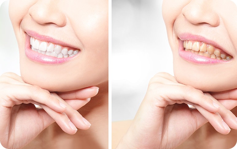 NE Calgary Teeth Whitening | Redstone Smiles Dental | General and Family Dentist | NE Calgary Dentist