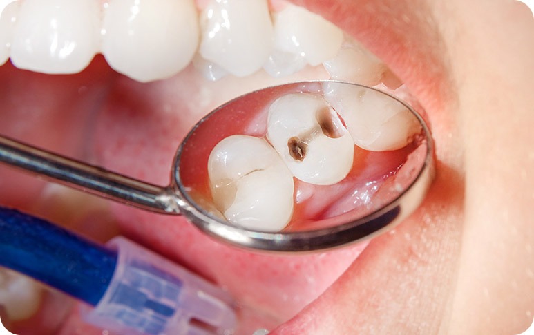 NE Calgary Tooth Coloured Match Fillings | Redstone Smiles Dental | General and Family Dentist | NE Calgary Dentist